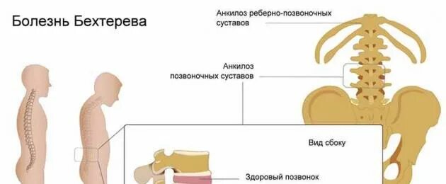 Какой рак передается по наследству. Болезнь Бехтерева передается ли по наследству. Болезнь Бехтерева передается по наследству детям. Передаются ли болезни желудка по наследству. Заболевания спины передающиеся по наследству.