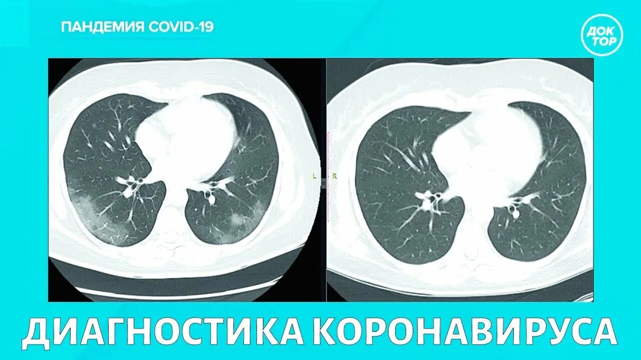 Кт после ковид