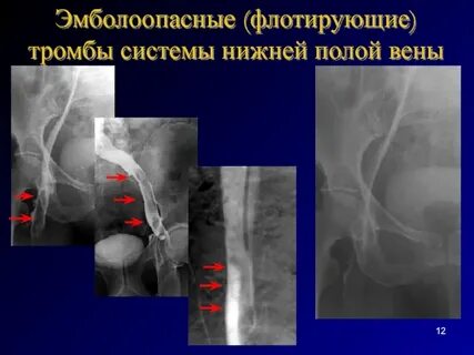 Флотирующие тромбы в венах
