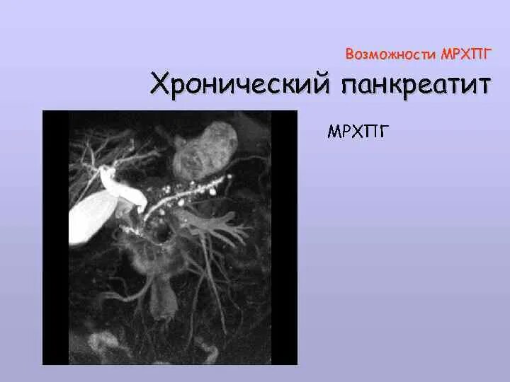 Магнитно резонансная холангиопанкреатография МРХПГ. МРХПГ поджелудочной железы. Магнитно-резонансная холангиография желчного пузыря. МРХПГ хронический панкреатит.