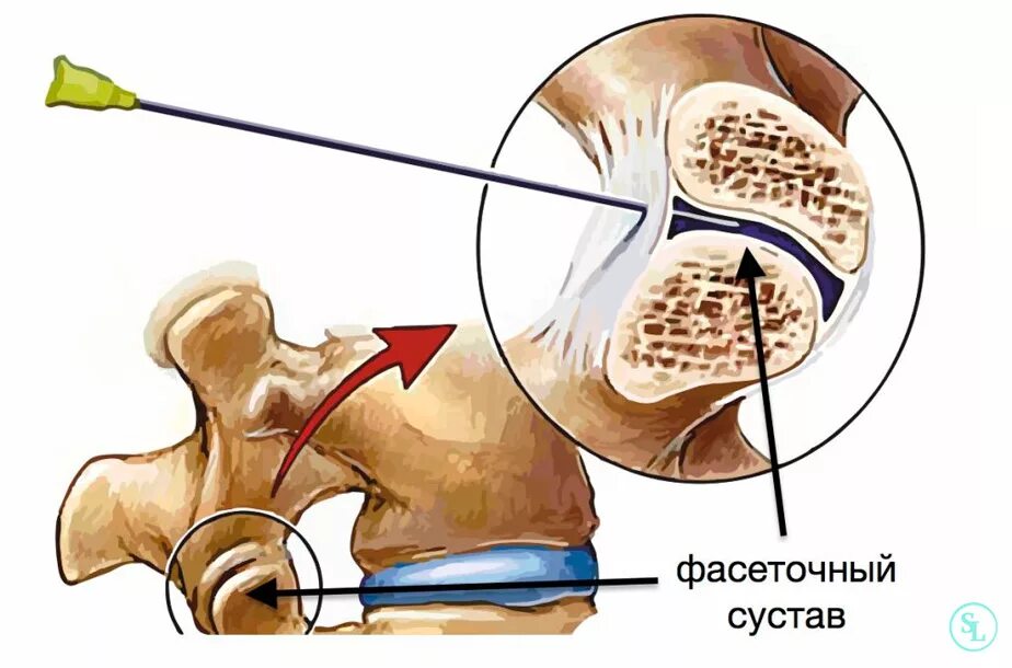 Сустав поясничного отдела. Фасеточные суставы поясничного отдела позвоночника. блокада фасеточных суставов поясничного отдела позвоночника. фасеточный сустав шейного отдела. блокада фасеточных суставов техника.
