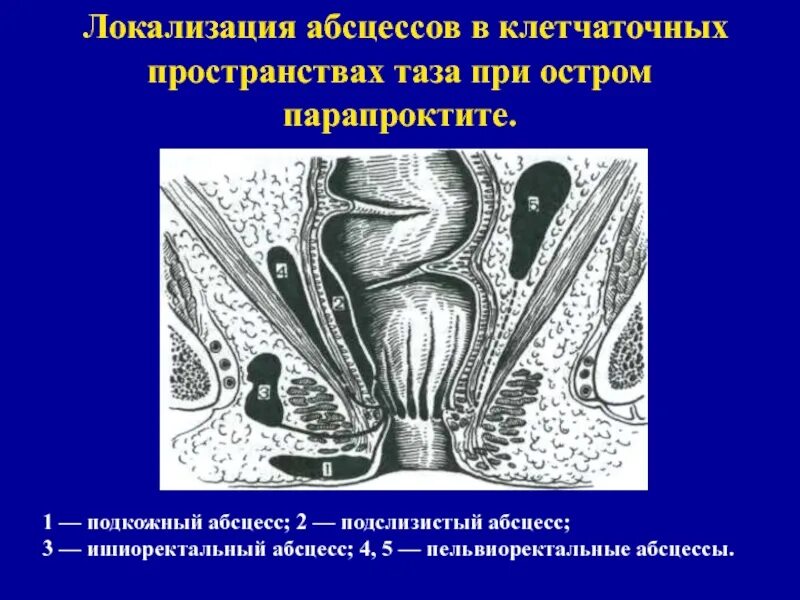 Пельвиоректальный парапроктит. Острый ишиоректальный парапроктит. Пельвиоректальный парапроктит расположение.