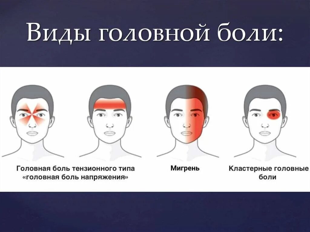 Интенсивность головных болей. Типы головной боли. характер и локализация головных болей. головные боли по зонам головы. локализация головной боли и причины.