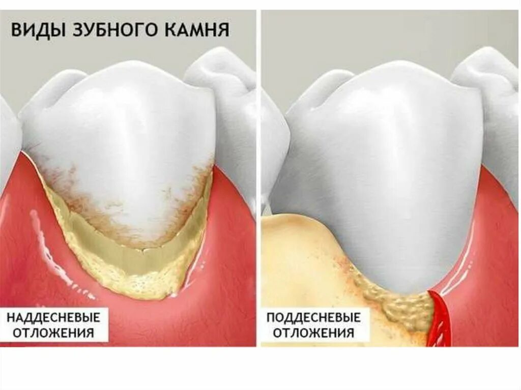Поддесневые отложения зубной камень. Пришеечный зубной камень. Десен после удаления зубного камня. Десен после удаления зубного камня. Десен после удаления зубного камня.
