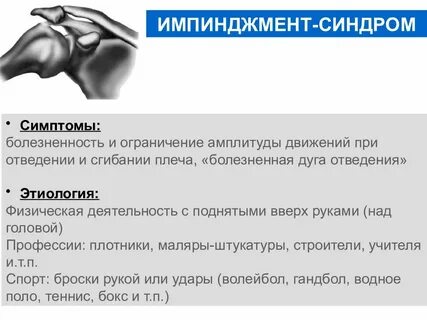 Субакромиальный импинджмент синдром плечевого сустава