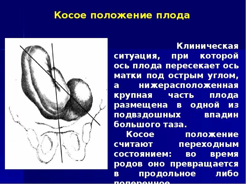 Косое положение плода. Неправильные положения плода поперечное косое. неправильное положение плода косое. косое головное положение плода. продольное поперечное косое положение плода.