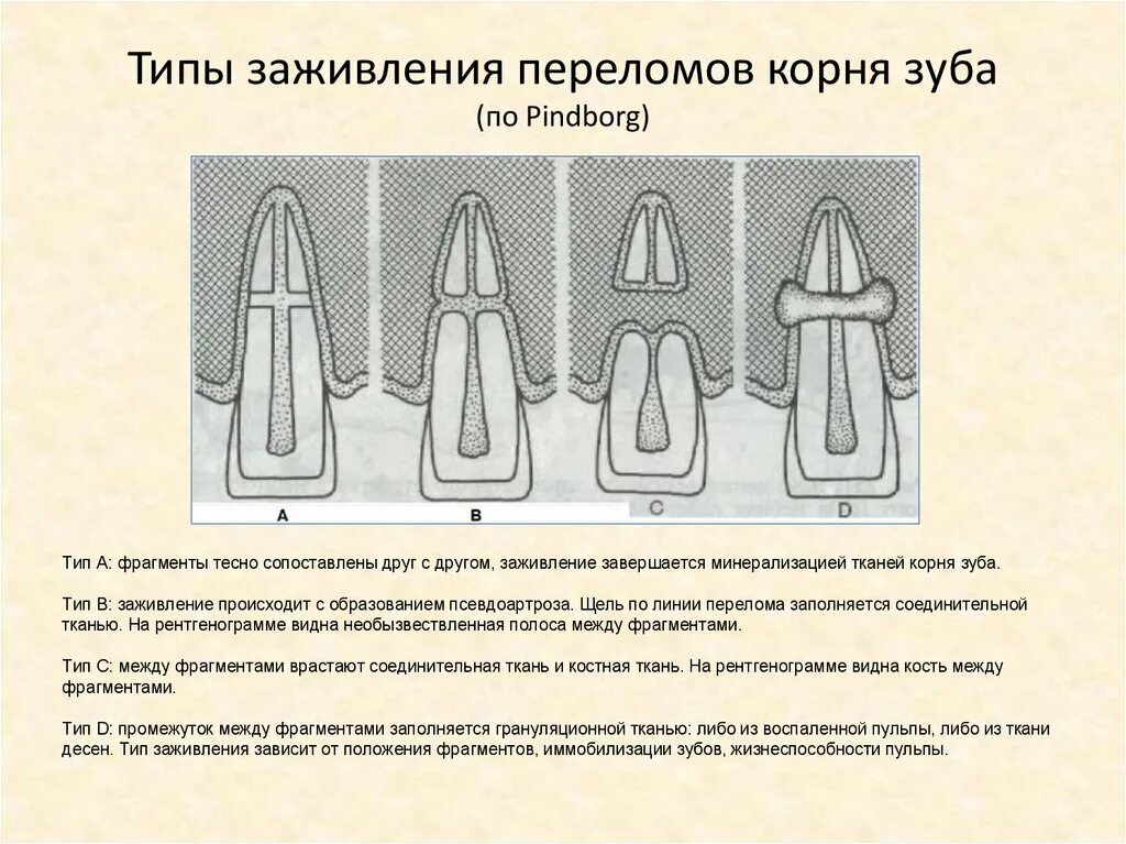 Переломы зубов классификация. Коронково-корневой перелом зуба. Продольный перелом корня зуба.