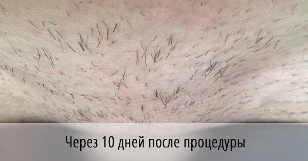 Как растут волосы после шугаринга. Волосы после лазерной эпиляции.