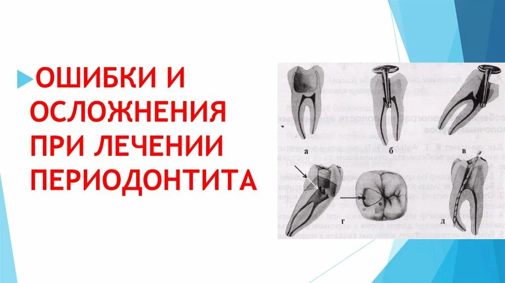 Ошибки и осложнения при лечении периодонтита. Ошибки при лечении периодонтита. Ошибки при лечении пульпита и периодонтита. Ошибки и осложнения при лечении верхушечного периодонтита. Осложнение лечения периодонтита