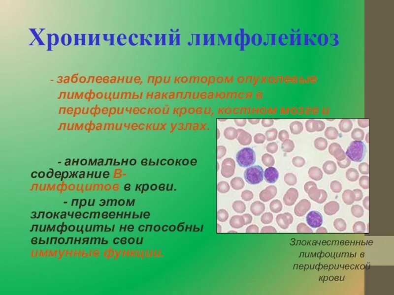 В -лимфоциты хронический лимфолейкоз. Лимфоциты при хроническом лимфолейкозе. Периферическая кровь при хроническом лимфолейкозе. Хронический лимфолейкоз кровь