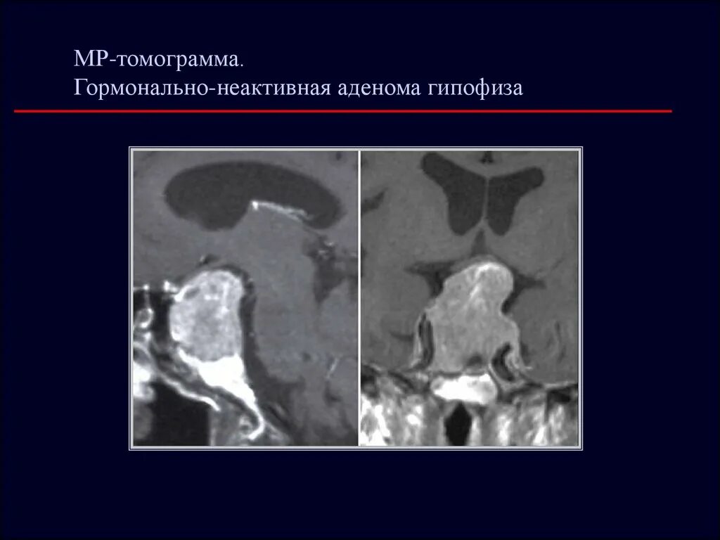 Опухоли гипофиза патанатомия. Аденома гипофиза патоморфология. Аденома гипофиза патанатомия. Соматотропная аденома гипофиза патанатомия.