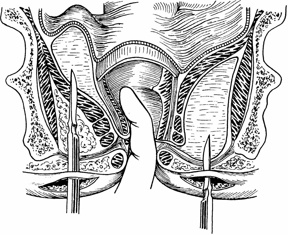 Как вылечить заднюю трещину. Гнойный ишиоректальный парапроктит. Пельвиоректальный парапроктит операция. Парапроктит параректальный свищ. Хронический парапроктит.