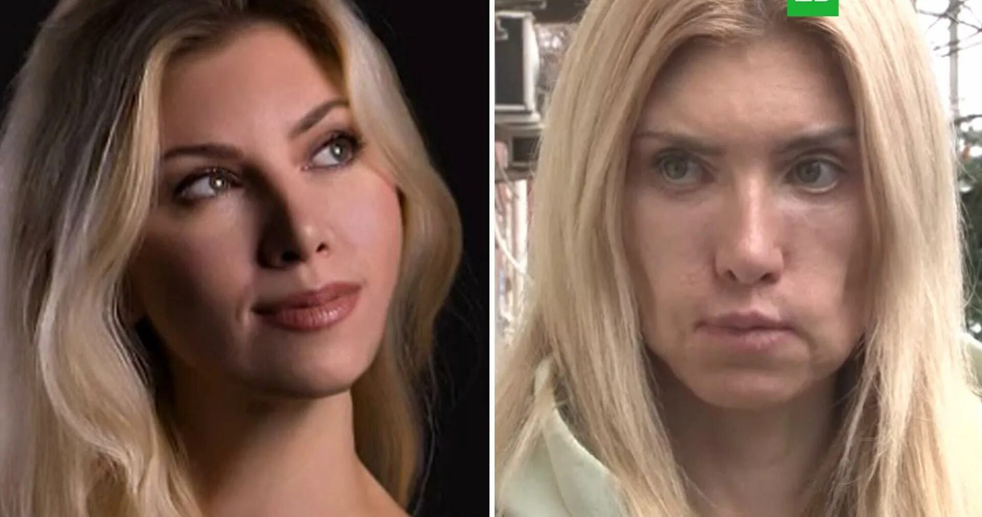 После пластической операции. Ирина шейк до и после пластики. Сочи пластическая хирургия изуродовали. Пластика лица. Неудачные пластические операции моделей.