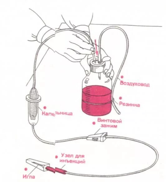 Устройство системы для внутривенного капельного вливания. Строение системы для внутривенного капельного вливания. Схема капельницы медицинской. Как собрать капельную систему для внутривенного вливания. Можно ли капельницу во время поста