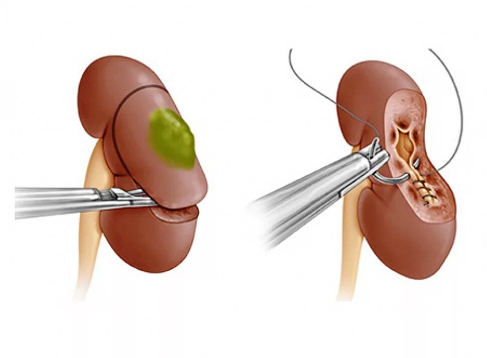 Нефрэктомия резекция почки. Нефрэктомия + тромбэктомия. Люмботомия нефрэктомия. Резекция почки что это