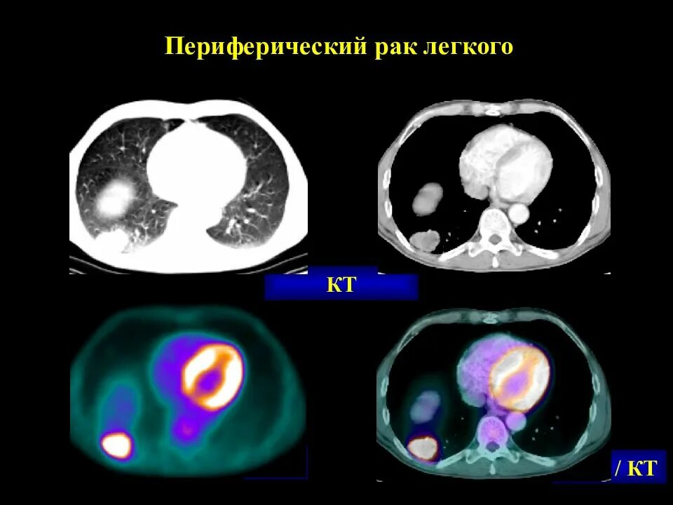 ПЭТ кт. ПЭТ кт изображение. ПЭТ кт снимки. Позитронно-эмиссионная томография (ПЭТ). Что можно перед пэт кт с контрастом