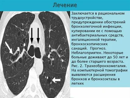 Пороки бронхолегочной системы