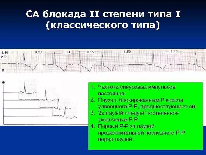 Комплекс блокада. Синоатриальная блокада II степени Тип 1. Синоатриальная блокада 2 степени 1 типа. Са блокада 2 степени Мобитц 1. Синоатриальная блокада Мобитц 1 ЭКГ.