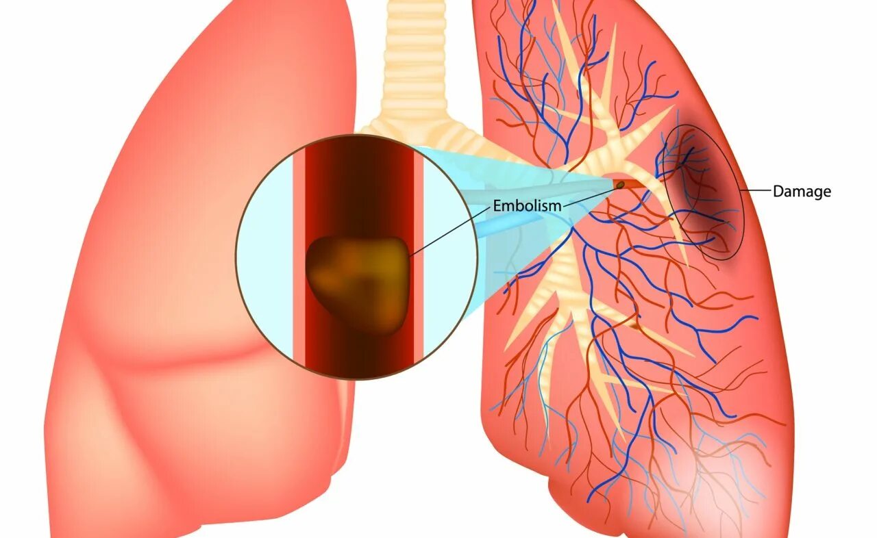 Тромбоэмболия легочной артерии. Тромбо легочная эмболия. Тромбофлебит легочной артерии. Оторвался тромб в легких