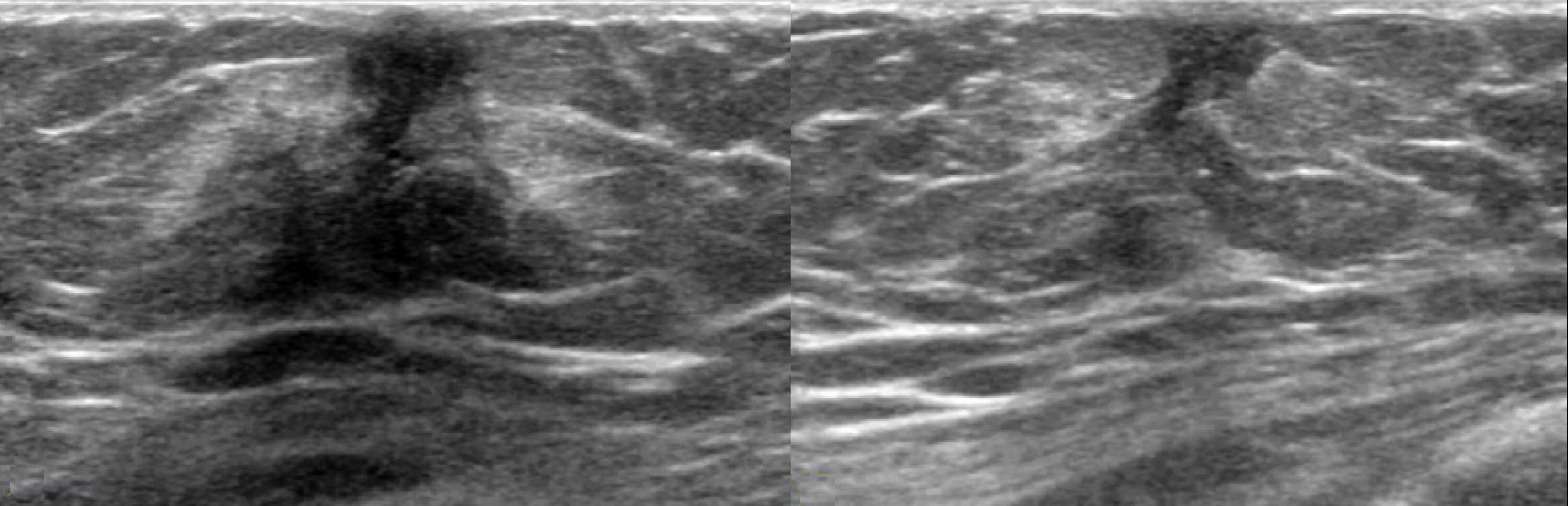 Саркома на узи. Фибролипома молочной железы УЗИ. Фибролипома мягких тканей на УЗИ. Инфильтрирующая карцинома молочной железы УЗИ. Атерома на УЗИ молочных желез.
