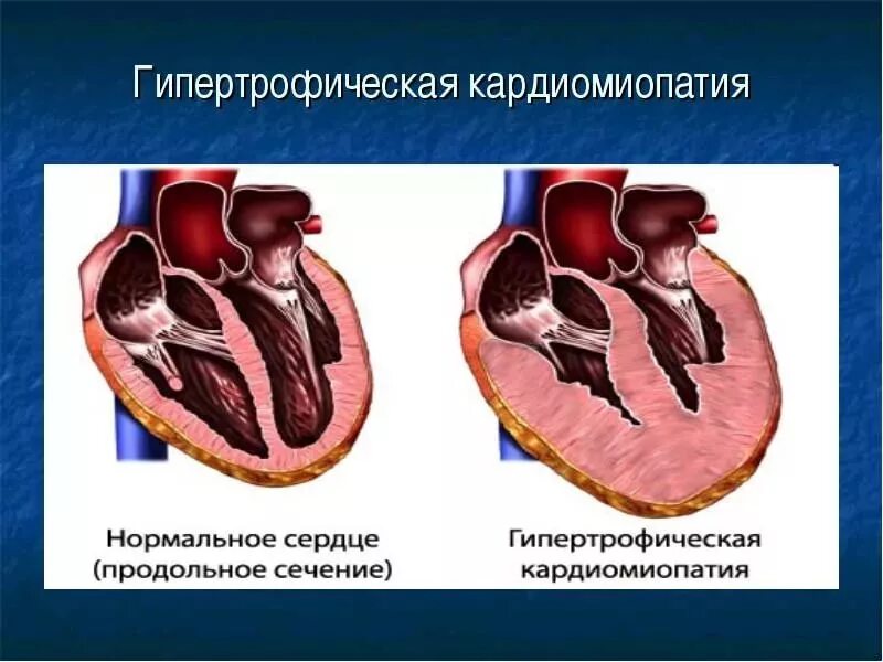 Диффузная сердца