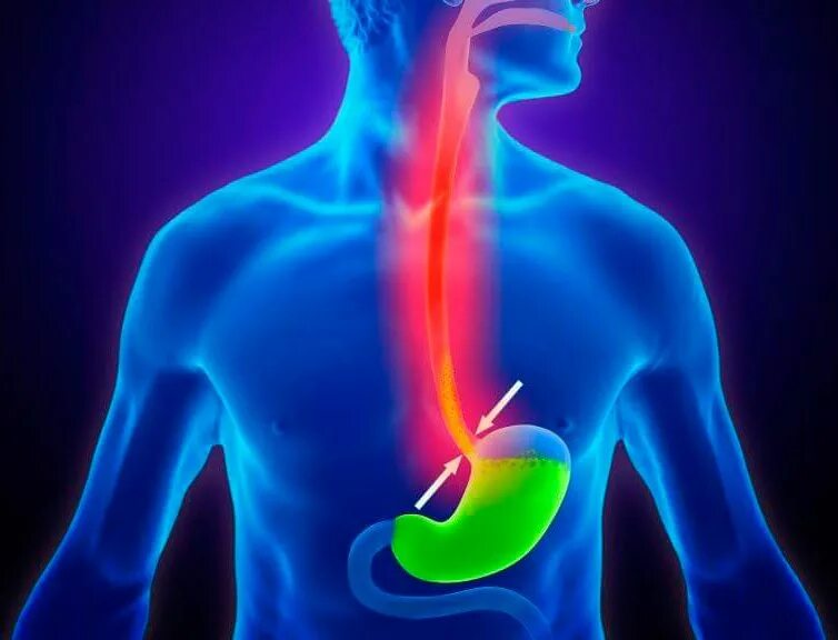 Рекомендации для беременных с изжогой. Изжога фото. Изжога 3. Изжога 3. Изжога 3.