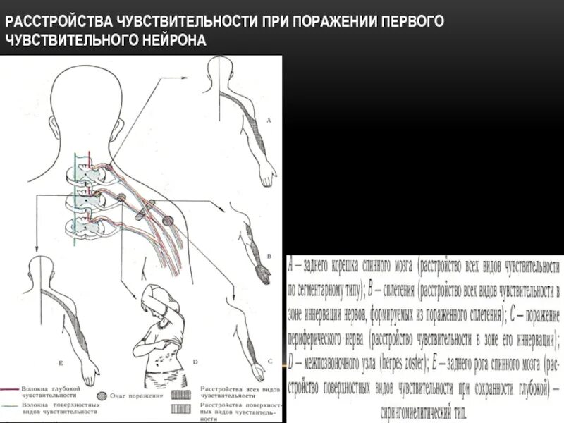 Сегментарный тип нарушения чувствительности неврология. Периферический тип нарушения. Поражение ствола периферического нерва. Периферический мононевритический тип нарушения чувствительности. Типы растройствчувствительности.