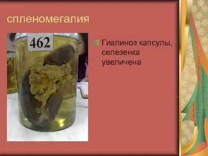 Капсула селезенки