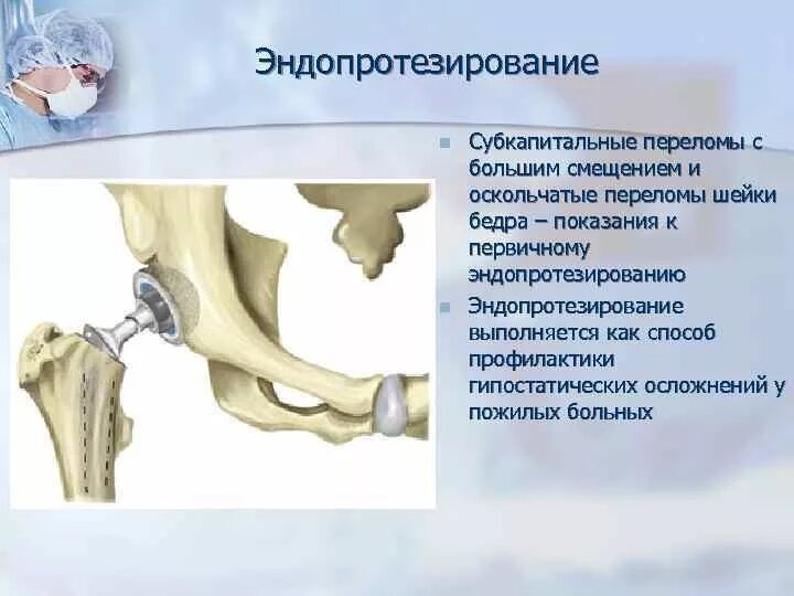 Субкапитальный перелом шейки бедра. Субкапитальный перелом шейки бедренной. Перелом бедренной кости в тазобедренном суставе. Аддукционные переломы шейки бедра. Перелом шейки бедра лечение операции