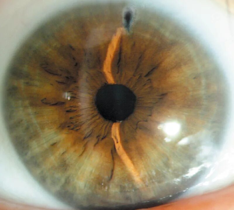 конъюнктивит и катаракта. обскурационная амблиопия. имплантация факичных интраокулярных линз. кератит помутнение роговицы. факичные интраокулярные линзы (иол).