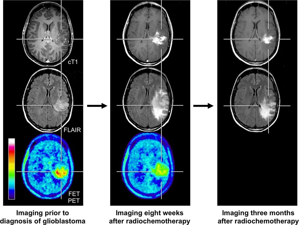 Кт после химиотерапии. ПЭТ кт с тирозином. ПЭТ кт амилоидная ангиопатия. ПЭТ-кт глиобластома.