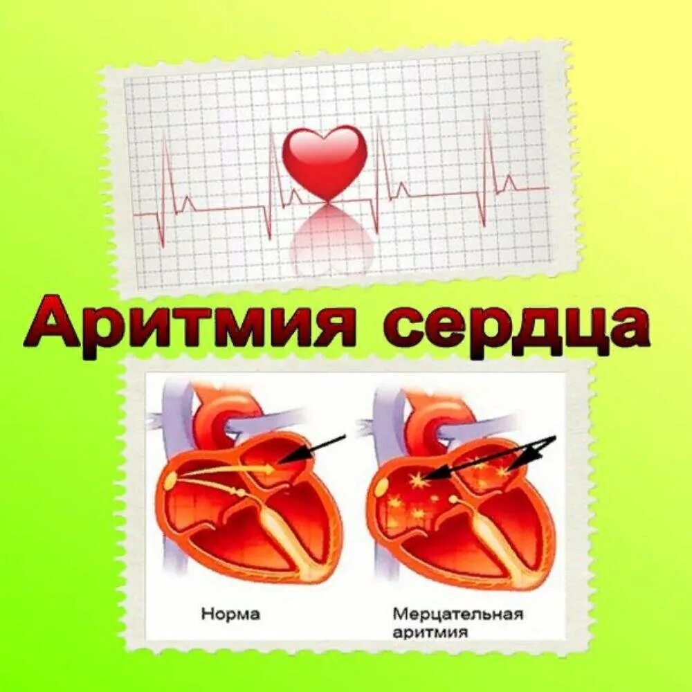 Сбивается сердечный ритм. Аритмия сердца. римия. аритмия сердца симптомы. нарушение сердечного ритма.