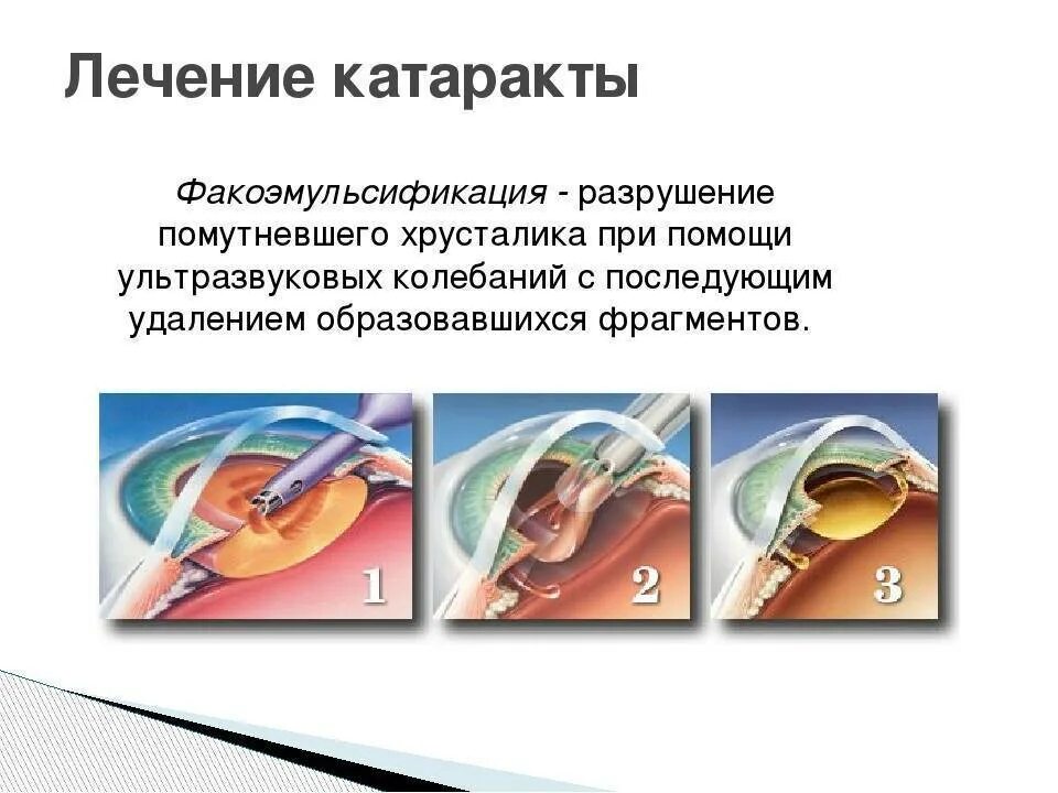 Развитие катаракты симптомы. Катаракта факоэмульсификация. основным методом лечения катаракты является. болезни хрусталика глаза.