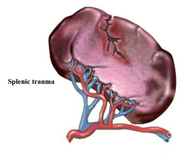 Селезенка армия. Разрыв капсулы селезенки. Чрезкапсульный разрыв селезенки. Кровотечение селезенки.