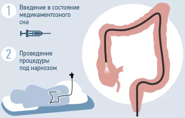 Колоноскопия под наркозом. Колоноскопия схема проведения. Схема проведения колоноскопии. Сколько по времени длится колоноскопия без наркоза