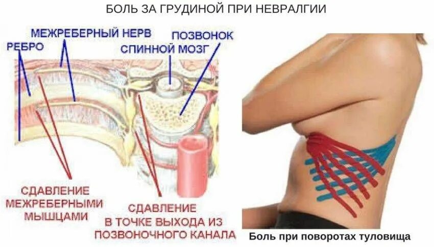 Болит сверху ребер. Невралгия межреберная невралгия. Межреберная невралоги. Межреберная нейровлагия. Межреберная невралгия грудной клетки.