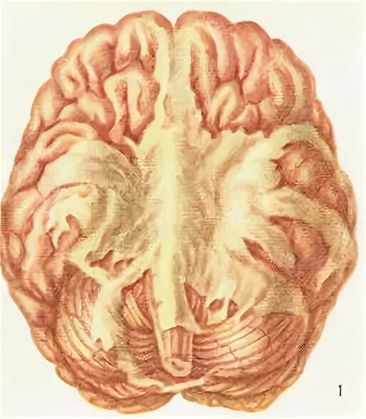 Мозговой туберкулез. Базилярный туберкулезный менингит. Базилярный туберкулезный менингит клиника. Менингоэнцефалит и туберкулезный менингит. Менингоэнцефалит патологическая анатомия.