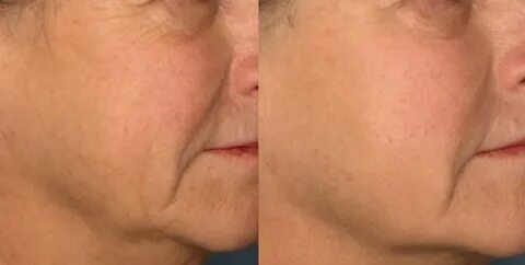 Picosure отзывы удаление