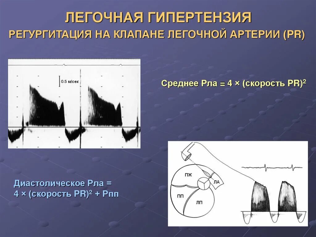 Эхокг сдла. Легочная гипертензия эхокардиография. эхокг при легочной гипертензии. легочная регургитация эхокг. лёгочная гипертензия 1 степени по эхокг.
