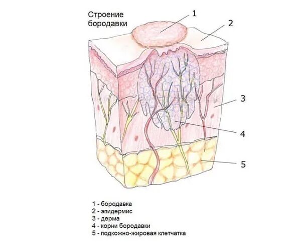 Как выглядит бородавка внутри кожи Warts Зображення - огляд 39,273 Стокові фото, векторні зображення й відео Adobe