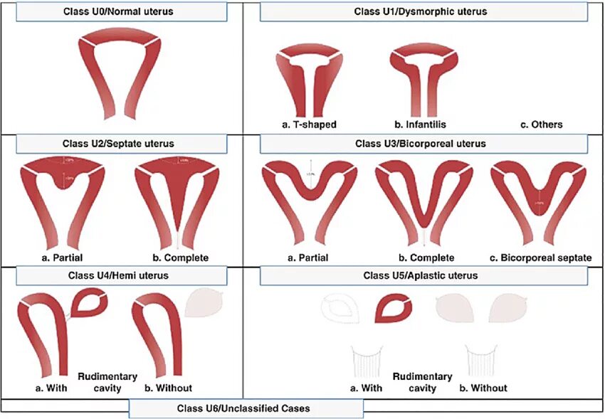 Форма полости матки. Аномалии развития матки классификация. Классификация аномалий развития матки ESHRE. Классификация пороков развития матки ESHRE. Удвоение матки классификация.