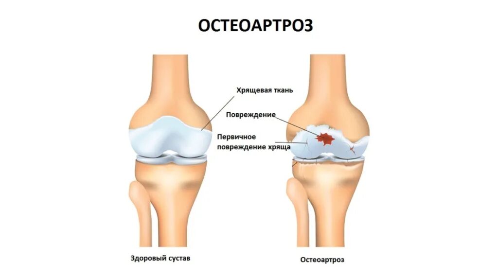 Суставы наиболее часто поражаются при