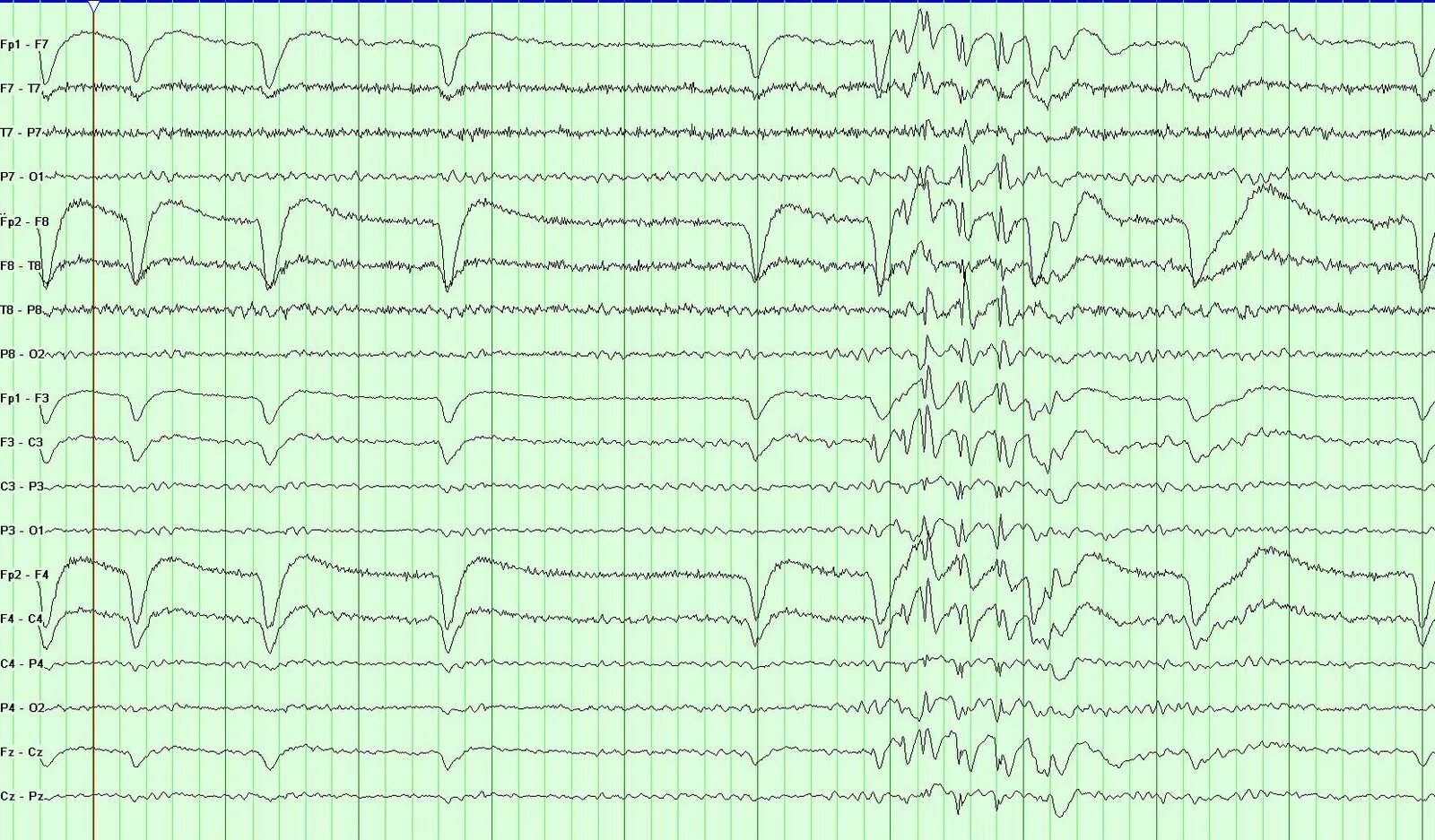 Потенциал ээг. Вертексные волны на ЭЭГ. Вертексные потенциалы на ЭЭГ. Энцефалограмма эпилепсия. ЭЭГ психофизиология.