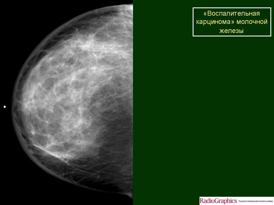 Фиброзно-кистозная мастопатия маммография. Рик молочной железы маммографич. Вид онкологии груди на маммографии. Онкология молочных желез симптомы