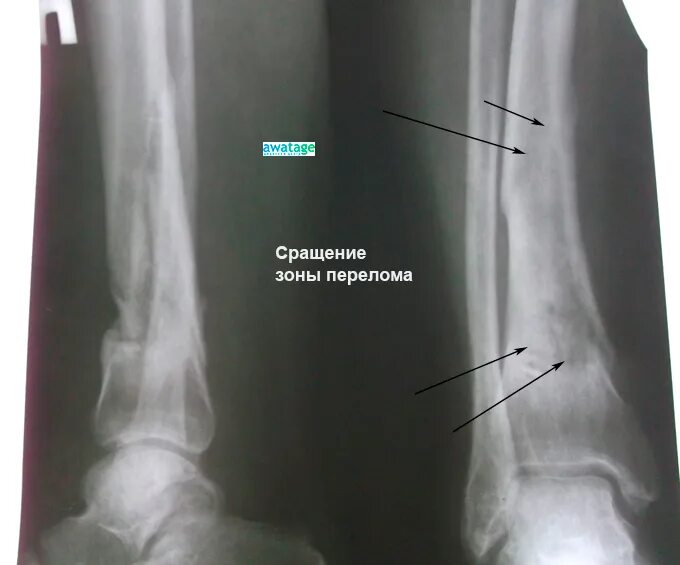 Сращение перелома костная мозоль. Костная мозоль перелом берцовой. Сросшийся перелом на рентгене. Костная мозоль после перелома берцовой кости на снимке. Не заметил перелом