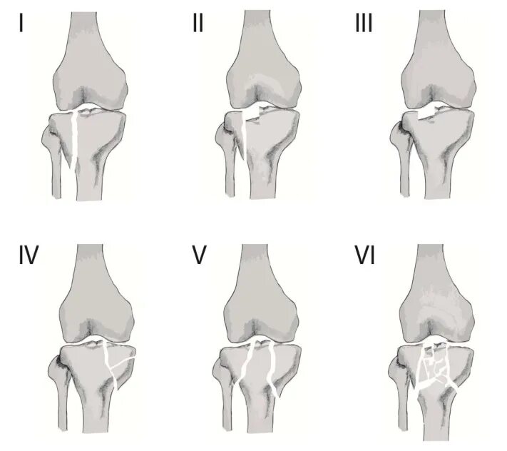 Перелом мыщелка большой. Переломы большеберцовой кости классификация. Перелом плато большеберцовой кости классификация. Классификация Шацкера переломов большеберцовой кости. Перелом мыщелка большеберцовой кости классификация.