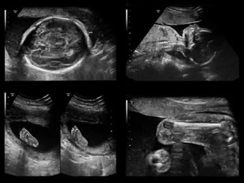 УЗИ скрининг 3 триместра беременности. УЗИ скрининг 1 триместра пол ребенка. УЗИ третий скрининг при беременности. УЗИ 3 триместр беременности.