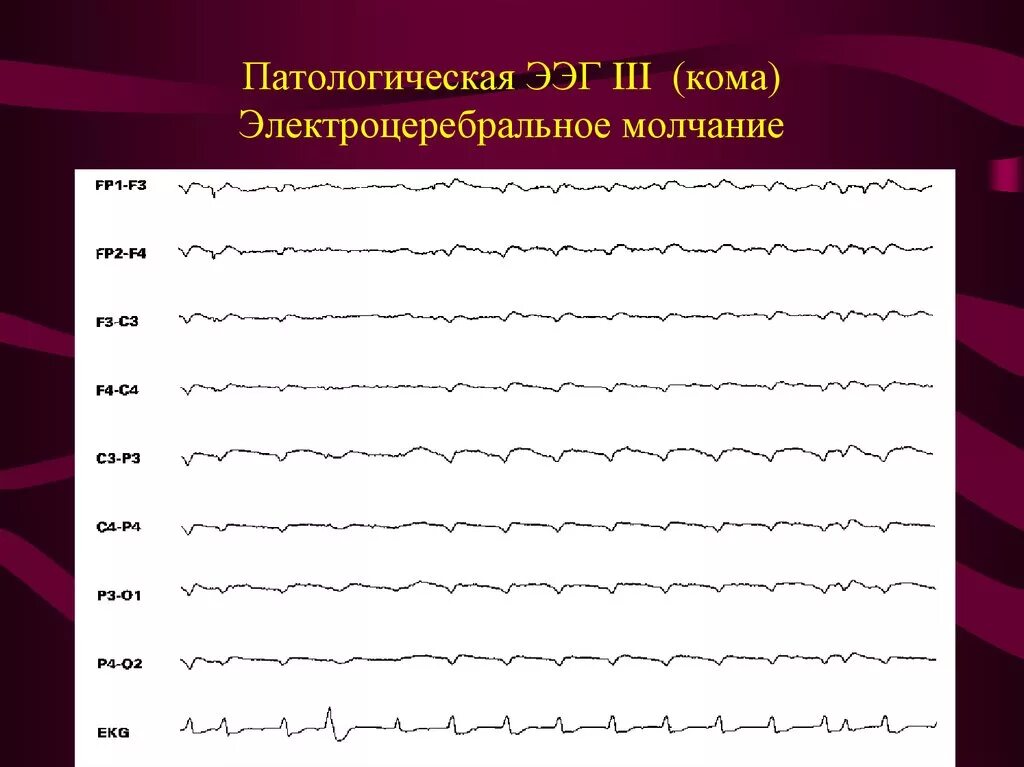 Сколько длится ээг. Вертексные потенциалы на ЭЭГ. Эпилептиформная активность на ЭЭГ. ЭЭГ паттерны патологические. ЭЭГ линии.