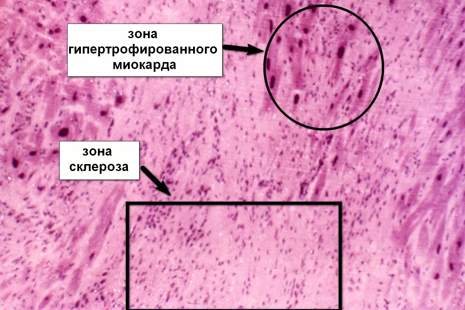 Диффузный мелкоочаговый. Гипертрофия кардиомиоцитов патанатомия. Постинфарктный кардиосклероз макропрепарат. Фиброз миокарда гистология. Гипертрофия миокарда препарат патанатомия.