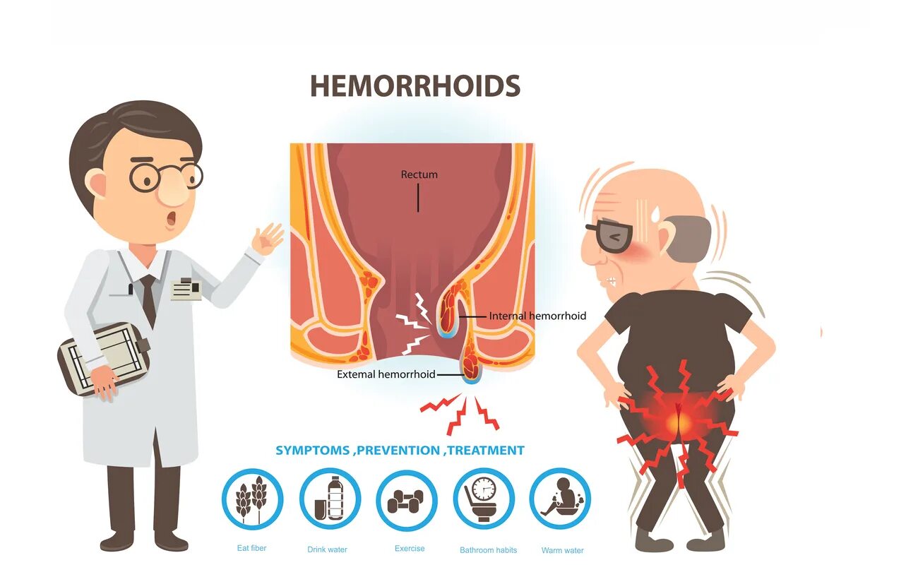 Причина кровотечения из заднего прохода у мужчин. Геморрой этиология патогенез. Предупреждение геморроя.
